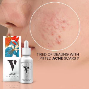Vcare Natural Acne Serum 30ml