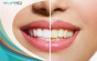 iShopping - Ayesha's Collection Hismile V34 Teeth Whitening